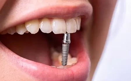 Имплантация зубов, костная пластика и их роль в здоровье человека